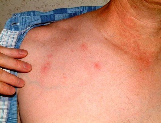příznaky parazitů pod kůží