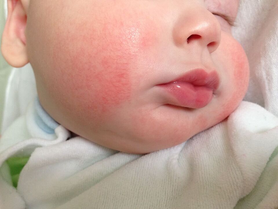 Známkou červů u dítěte je alergická kopřivka